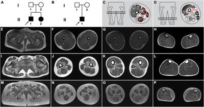 First Identification of Rare Exonic and Deep Intronic Splice-Altering Variants in Patients With Beta-Sarcoglycanopathy